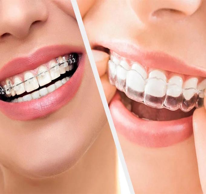 clear aligners treatment at smaindyo dental care, Thiruvananthapuram (or Trivandrum)