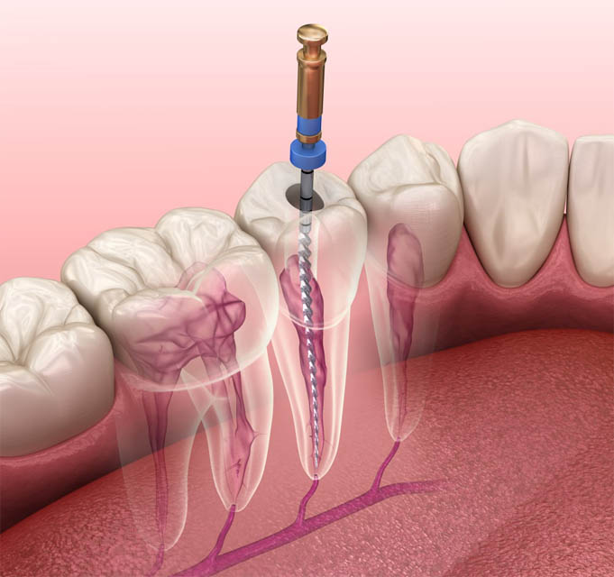 root canal treatment at smaindyo dental care, Thiruvananthapuram (or Trivandrum)