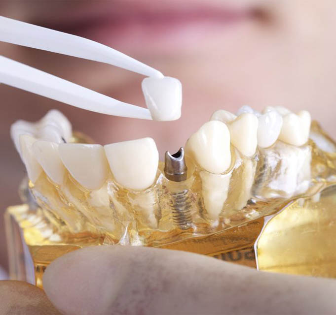 dental treatment at smaindyo dental care, Thiruvananthapuram (or Trivandrum)